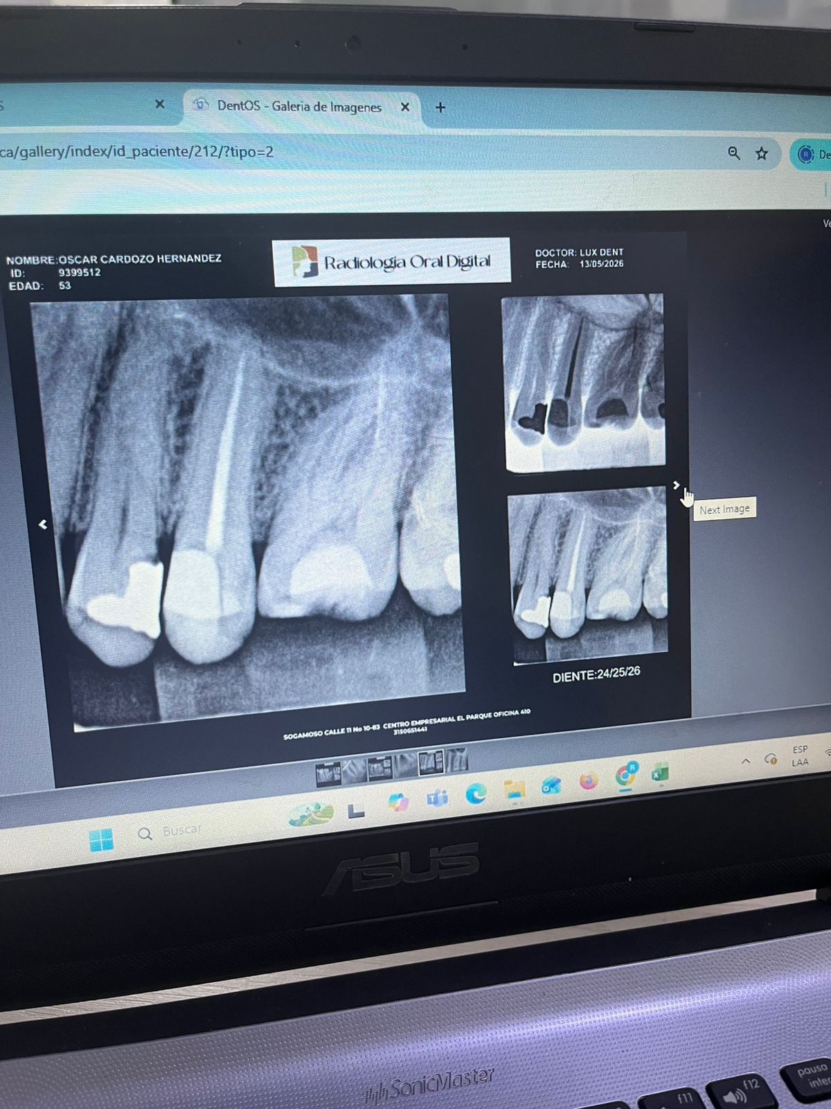 Endodoncia con instrumentación rotacional Lux Dent
